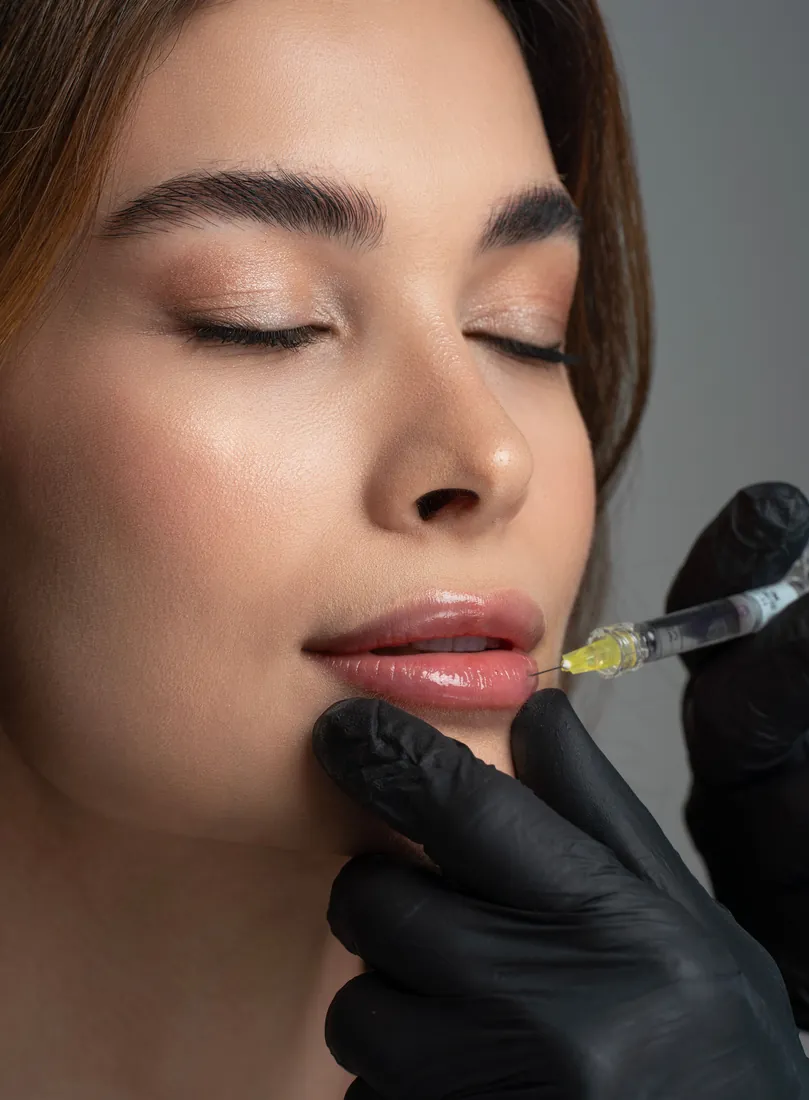 Russian Lips in Düsseldorf — Lippenfiller mit vertikaler Technik beim Facharzt